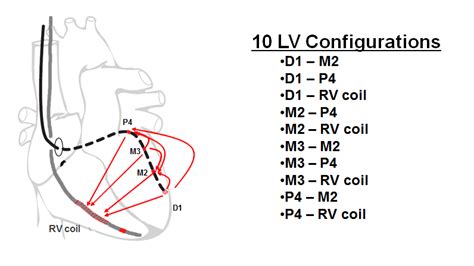 lv2 lv3 lv maturità|Quadripolar LV lead threshold test .